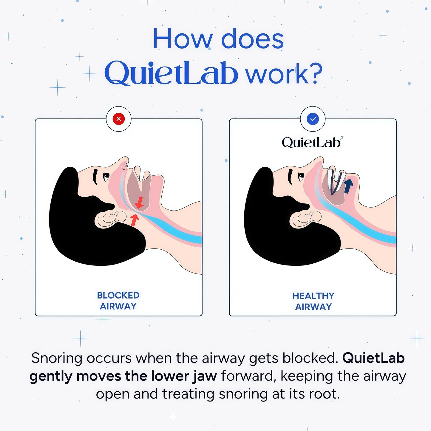 QuietLab Pro Anti-Snoring Mouthpiece